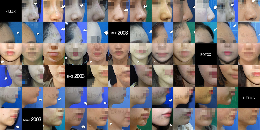 SINCE 2003 MI&MI, 시술후사진모음 서면바비인형주사, 서면역바비인형주사