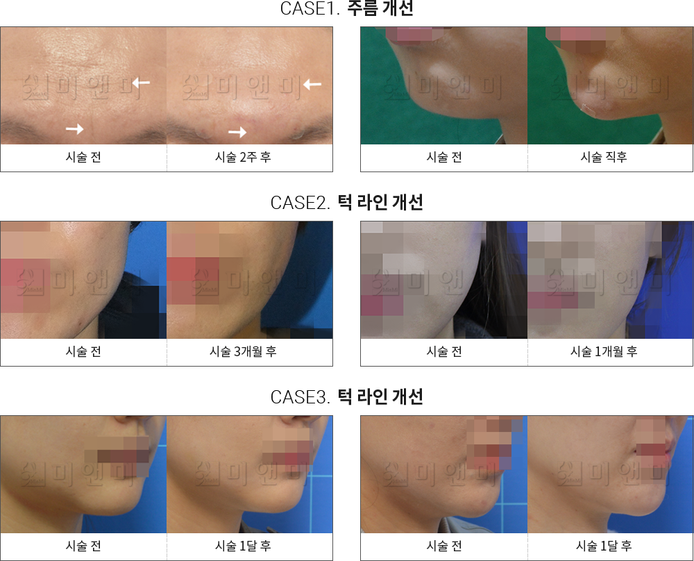 시술전후사진 주름 보톡스 : 주름 개선, 턱 라인 개선 서면피부과-서면역피부과 고민할 필요 없이 해결해 서면피부과 미앤미