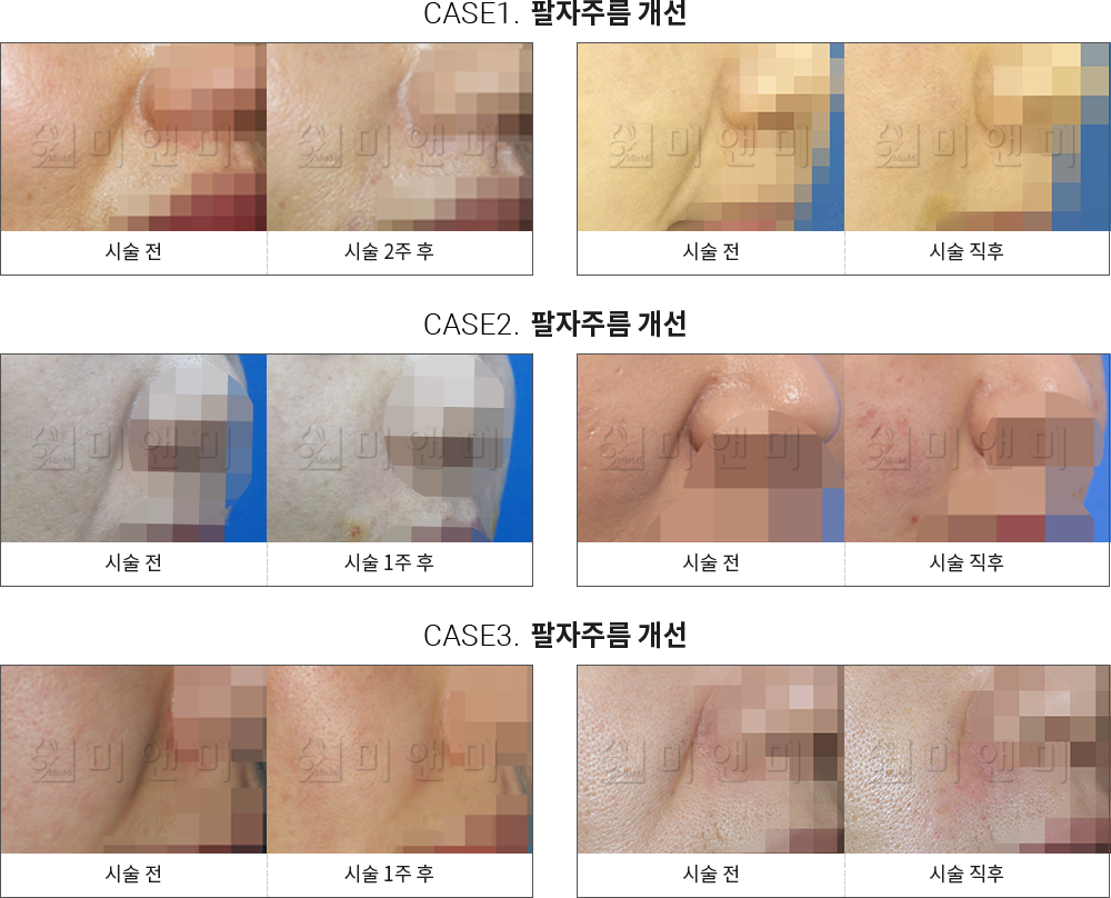 시술전후사진 팔자필러 : 팔자주름 개선 서면피부과-서면역피부과 고민할 필요 없이 해결해 서면피부과 미앤미
