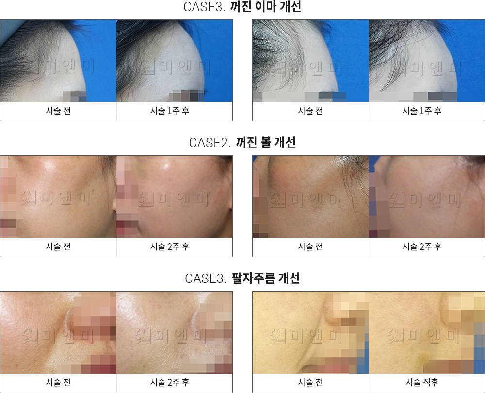 시술전후사진 엘라쎄 : 꺼진 이마 개선,꺼진 볼 개선,팔자주름 개선 서면피부과-서면역피부과 고민할 필요 없이 해결해 서면피부과 미앤미